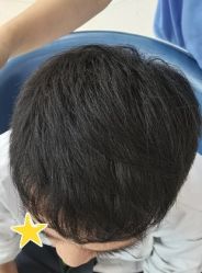 -大麦微针植发丨全国连锁