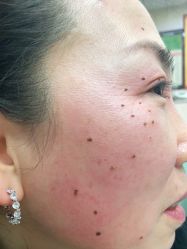 -北京美痣堂古方祛痣斑疣瘊