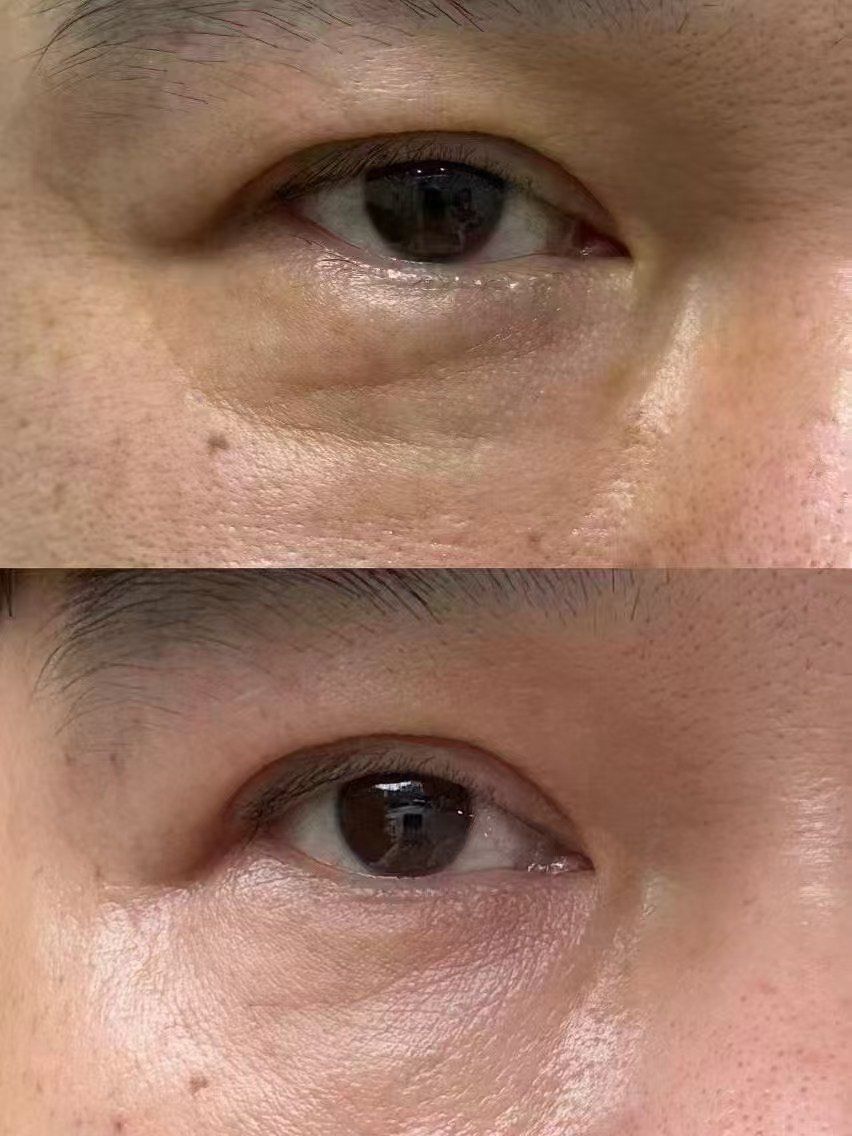 眼下真性细纹的产生,主要是因为胶原蛋白和