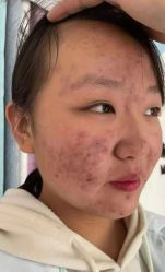 -瑶芳清颜草本祛痘