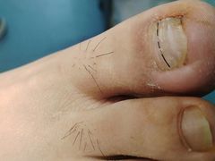 -祖传修脚甲沟炎灰指甲鸡眼