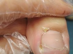 -祖传修脚甲沟炎灰指甲鸡眼