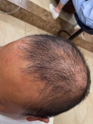 -碧莲盛·不剃发植发