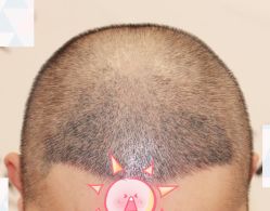 -大麦微针植发全国连锁