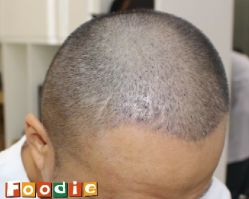 -大麦微针植发丨全国连锁