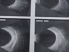 -成都新视界眼科医院·近视手术·儿童近视