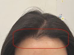 -大麦微针植发全国连锁