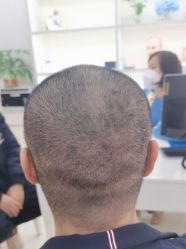 -大麦微针植发丨全国连锁