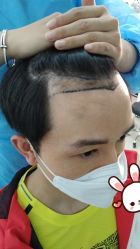 -大麦微针植发丨全国连锁