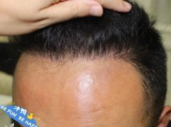 -大麦微针植发丨全国连锁