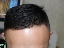 -大麦微针植发丨全国连锁