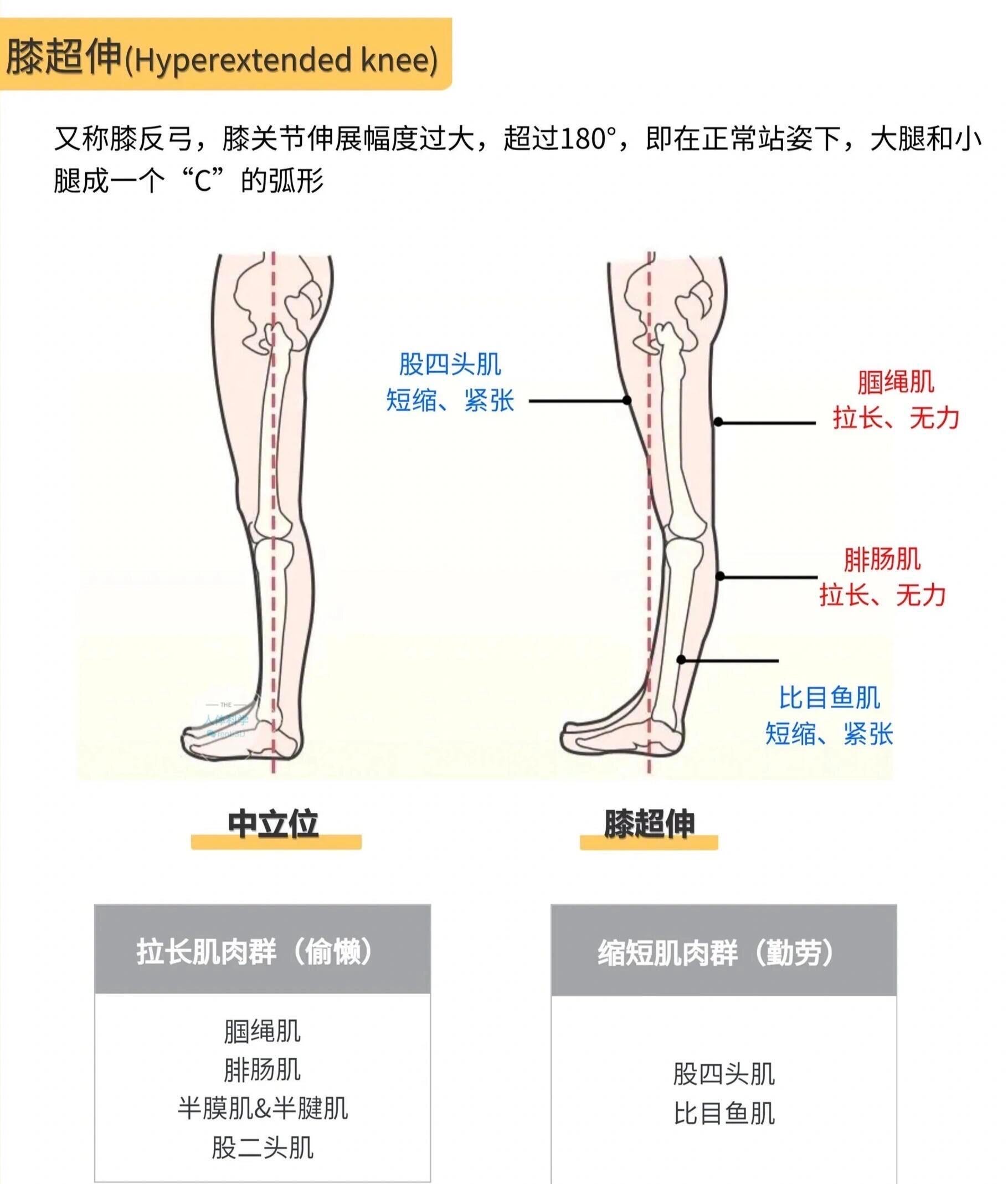 膝超伸锻炼方法来了