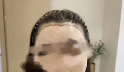 体验前-东莞缔美美容医院