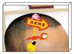 -大麦微针植发全国连锁