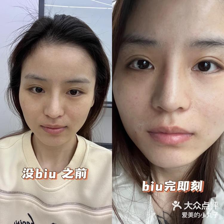 鼻基底填充前后对比90 -大众点评
