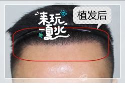 -大麦微针植发全国连锁