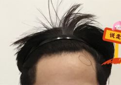 -大麦微针植发全国连锁