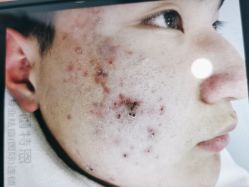 体验前-蕾特恩专业祛痘·皮肤管理