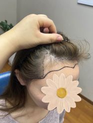 点击看大图 -大麦微针植发全国连锁