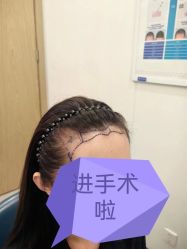 体验前-大麦微针植发全国连锁