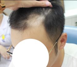 -大麦微针植发全国连锁