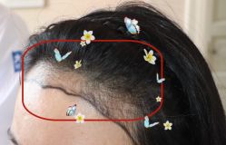 -大麦微针植发全国连锁