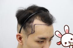 -大麦微针植发丨全国连锁