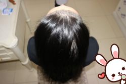 点击看大图 -大麦微针植发丨全国连锁