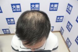 -大麦微针植发丨全国连锁