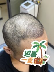 点击看大图 -大麦微针植发全国连锁