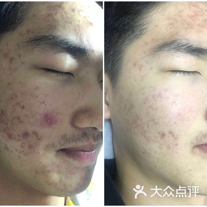 沁岚府祛痘祛斑美肌管理