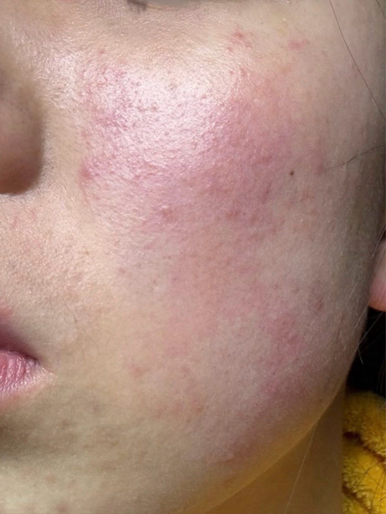 过敏性皮肤如何自救