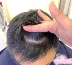 -大麦微针植发丨全国连锁