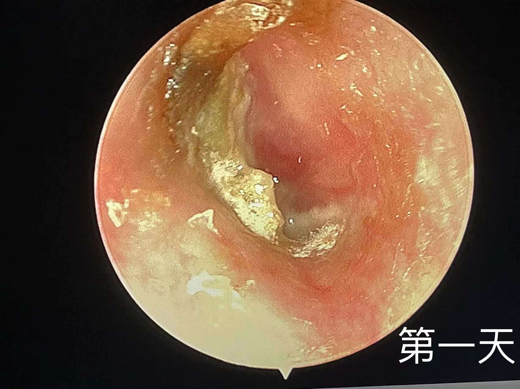 耳膜穿孔3分之一图片图片