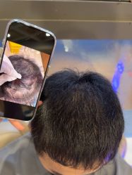 -碧莲盛·不剃发植发