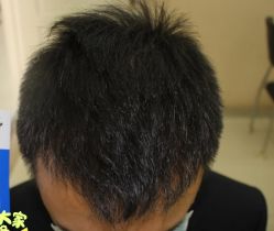 -大麦微针植发丨全国连锁