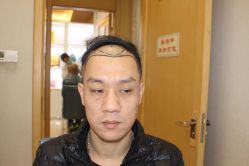 点击看大图 -大麦微针植发丨全国连锁