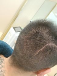 -碧莲盛·不剃发植发