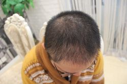 点击看大图 -大麦微针植发丨全国连锁