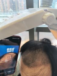 -碧莲盛·不剃发植发