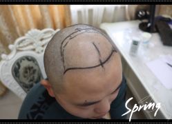 -大麦微针植发全国连锁