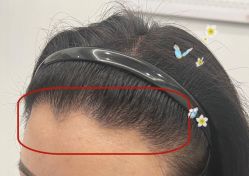 -大麦微针植发全国连锁