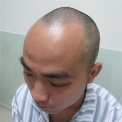 -碧莲盛·不剃发植发