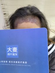 -大麦微针植发丨全国连锁