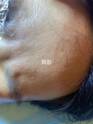 -爱莎扁平疣·汗管瘤·斑痣中心