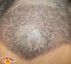 -大麦微针植发丨全国连锁