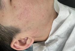 -宜肤清颜专业祛痘问题肌修护