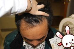 点击看大图 -大麦微针植发丨全国连锁