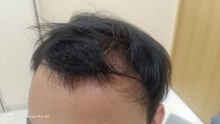 -碧莲盛·不剃发植发