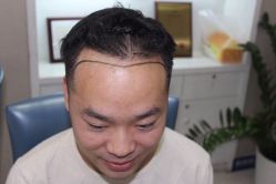 -大麦微针植发全国连锁